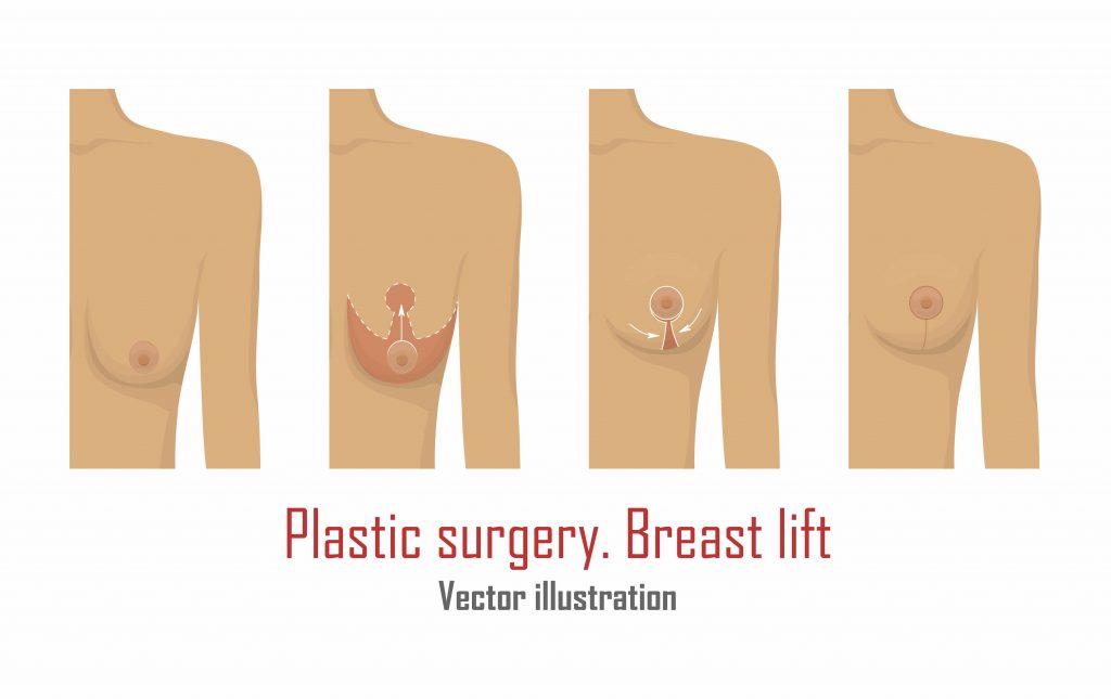 Motivations behind Women's Decision for Breast Lift Surgery